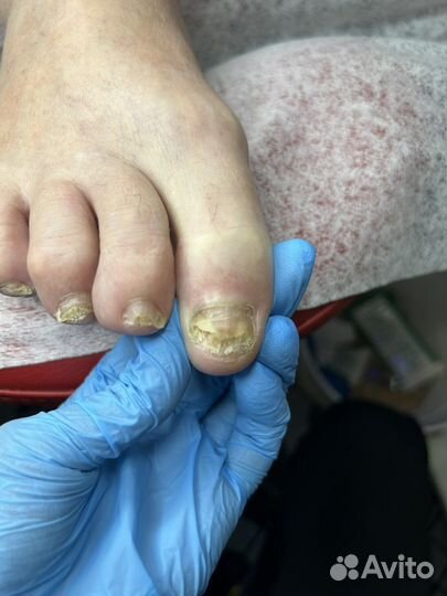 Лечебный педикюр