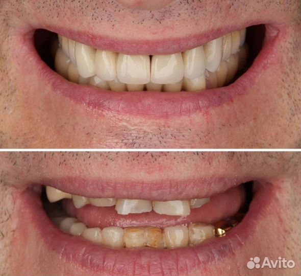 Съемные зубные протезы