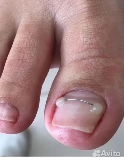 Коррекция вросшего ногтя, медицинский педикюр