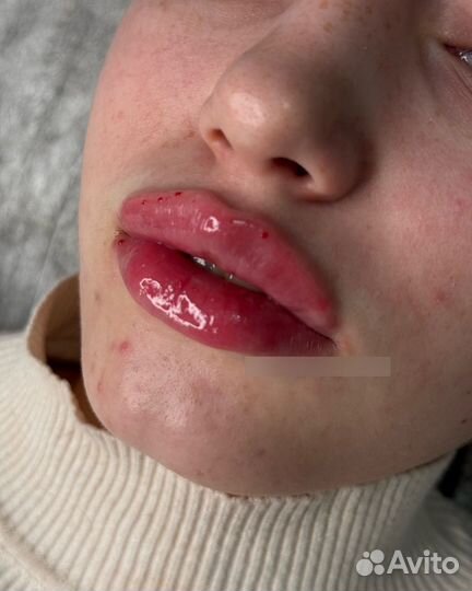 Увеличение губ