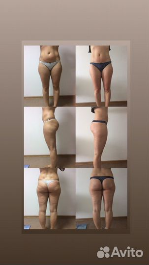 Аппаратная коррекция фигуры