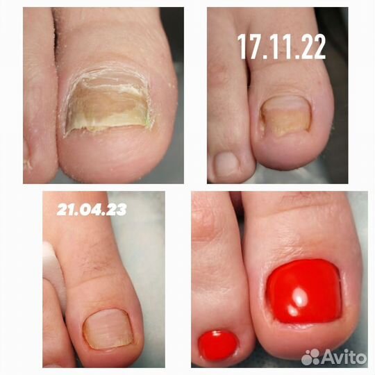 Медицинский педикюр подолог