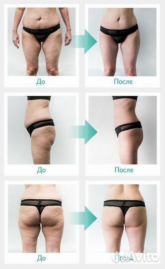 Модель на криолиполиз