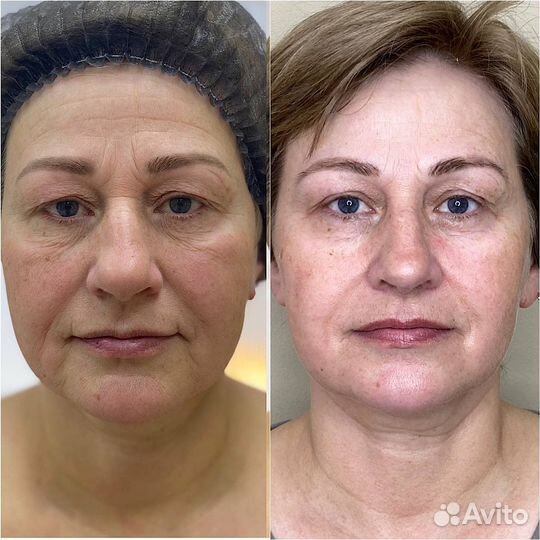 Косметолог без иголок