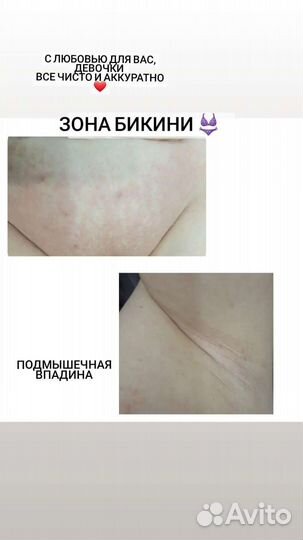 Депиляция