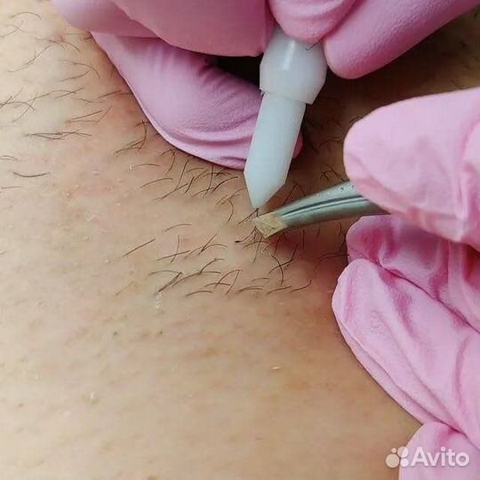 Электроэпиляция