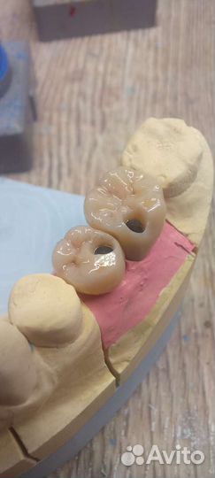 Цирконевые коронки анатомия