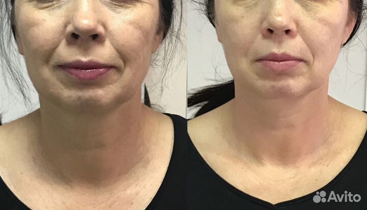 Холодная плазма