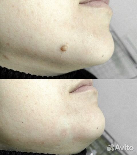 Удаление папиллом, родинок, бородавок