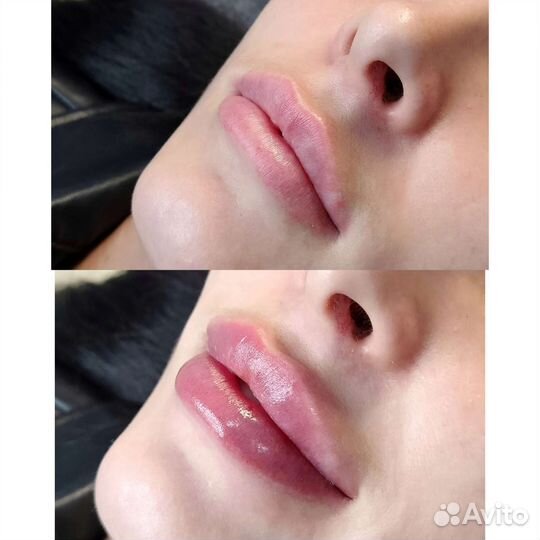 Косметолог:Увеличение губ,ботокс,уходы,прокол ушей