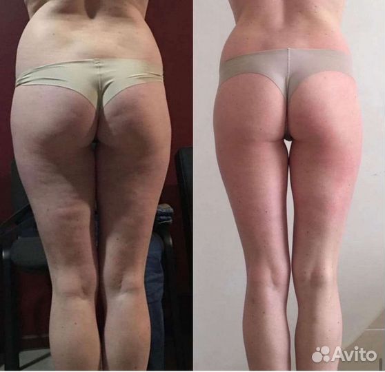 Вакуумный РФ лифтинг. Акция всего