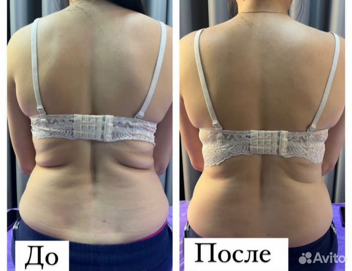 Похудение Турбо-Жиротоп Липосоник