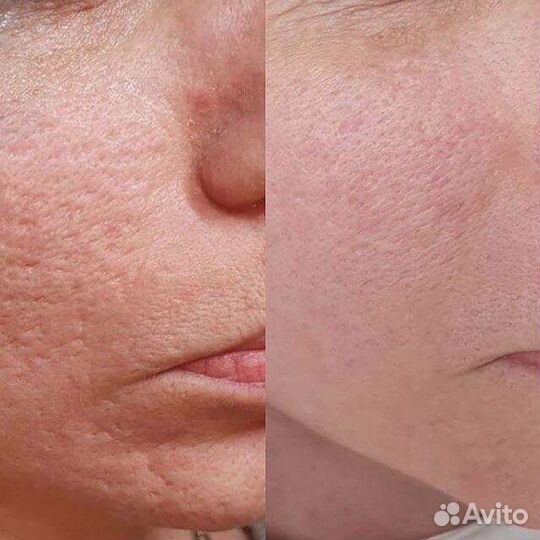 Холодная плазма