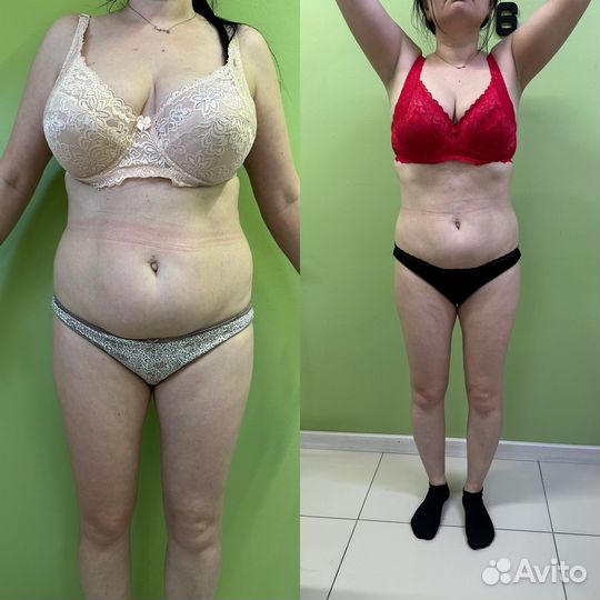 Аппаратный вакуумный массаж вибромассаж