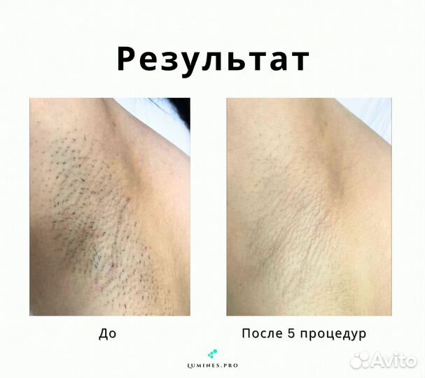 Аппарат для эпиляции Lumines’ максван 1200вт