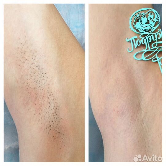 Лазерная эпиляция Санкт-Петербург