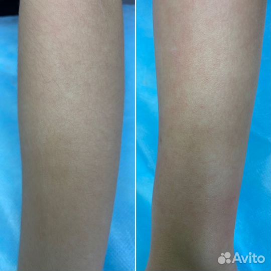 Депиляция/электроэпиляция