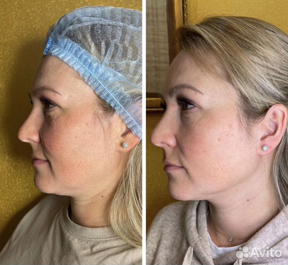 Омоложение холодной плазмой