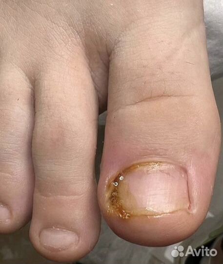 Вросший ноготь Подолог