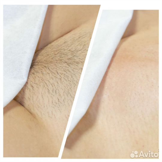 Шугаринг. Депиляция воском