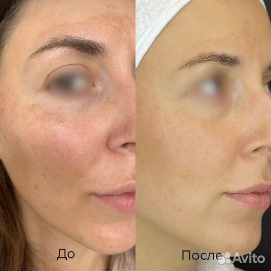 BBL Forever Young RF lifting