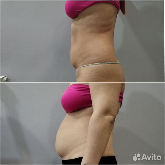 Аппаратный массаж