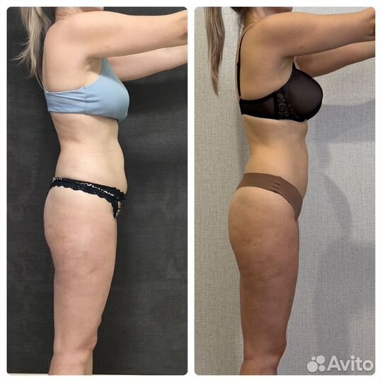 Антицеллюлитный массаж