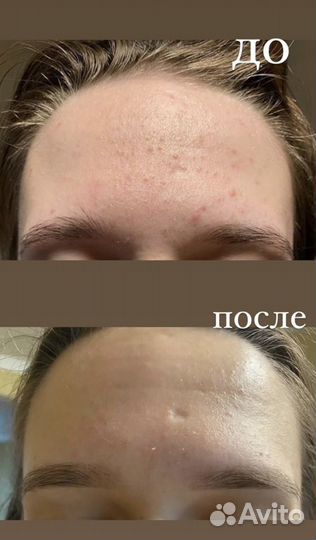 Чистка лица, пилинг