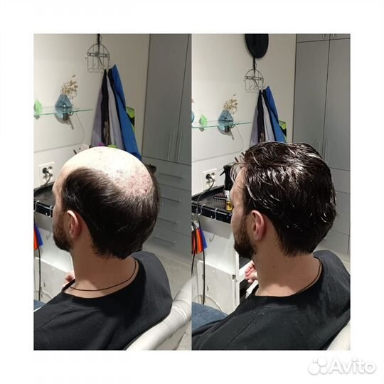 Установка мужской системы замещения волос