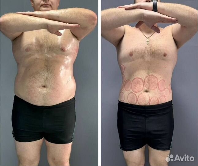 LPG массаж. Коррекция фигуры. Похудение