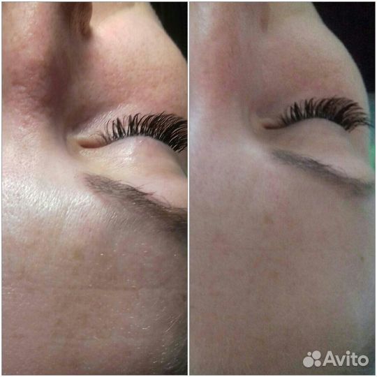 Чистка лица,пилинги