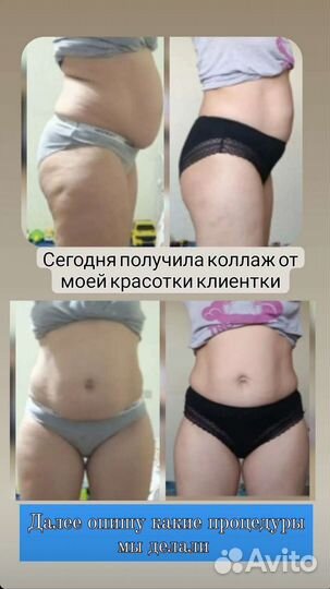 Криолиполиз на новейшем аппарате. Прессотерапия