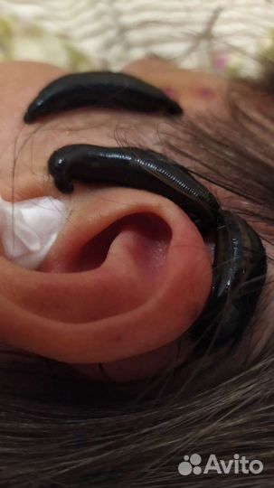 Купон на гирудотерапию