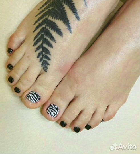 Вросший ноготь Онихолизис Титановая нить Подолог