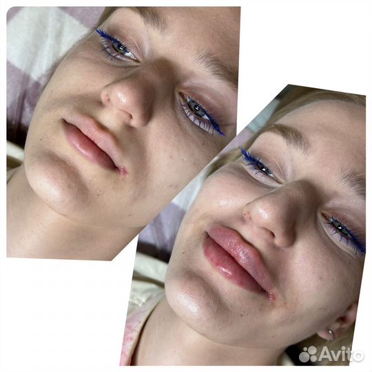 Косметолог /увеличение губ/ ботокс/мезо /плазма