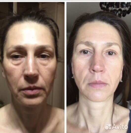 Массаж лица