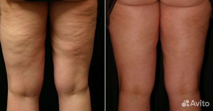 Антицеллюлитный массаж тела