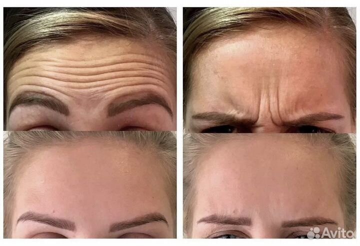 Требуются модели на ботокс