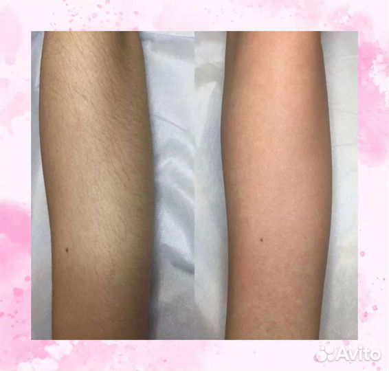 Шугаринг сахарной пастой