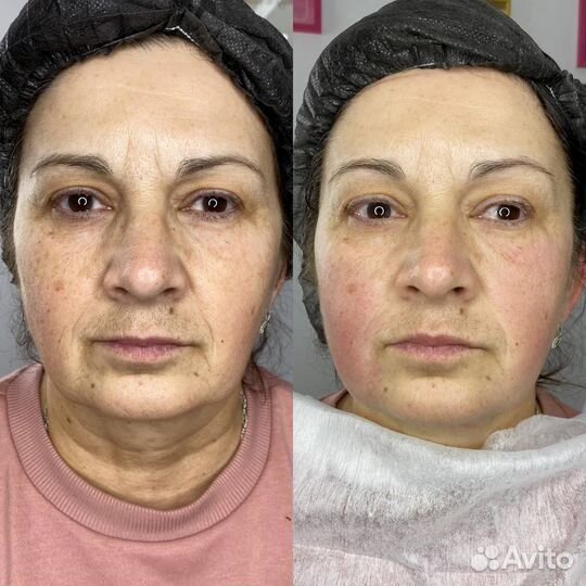 Модели SMAS лифтинг