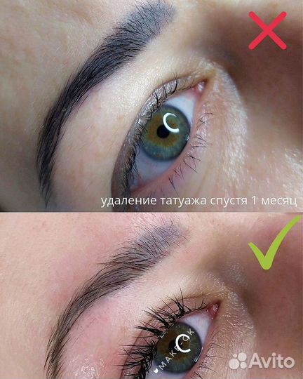 Удаление татуажа ремувером