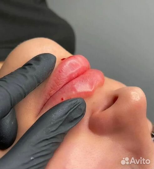 Увеличение губ. Без боли