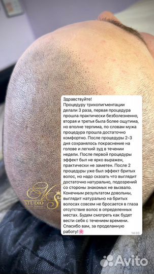 Трихопигментация SMP головы