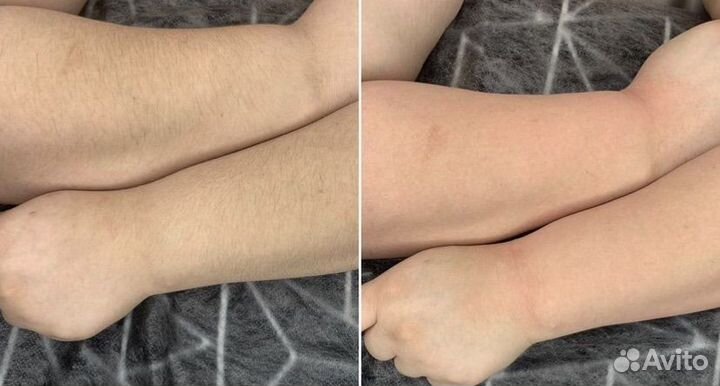 Шугаринг сахарная депиляция