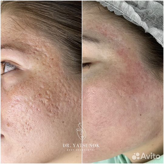 Лазерная шлифовка с охлаждением