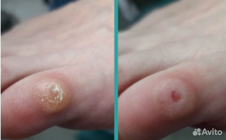 Стержневая мозоль