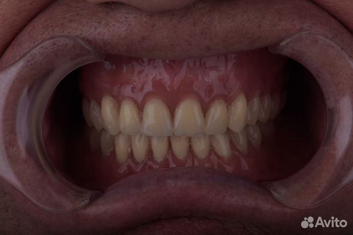 Зубные протезы