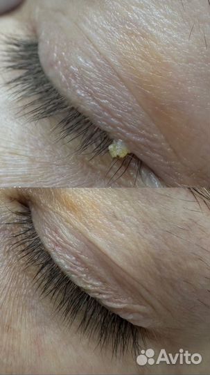 Удаление папиллом