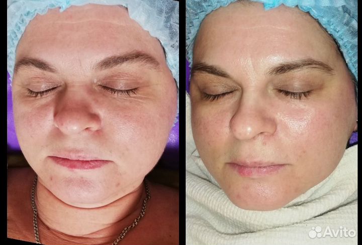 Вакуумный массаж. Кавитация. РФ лифтинг