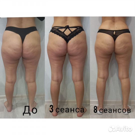 Антицеллюлитный массаж,коррекция фигуры,кавитация